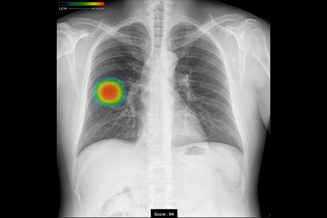 胸部X線画像病変検出ソフトウェア(CXR-AID)